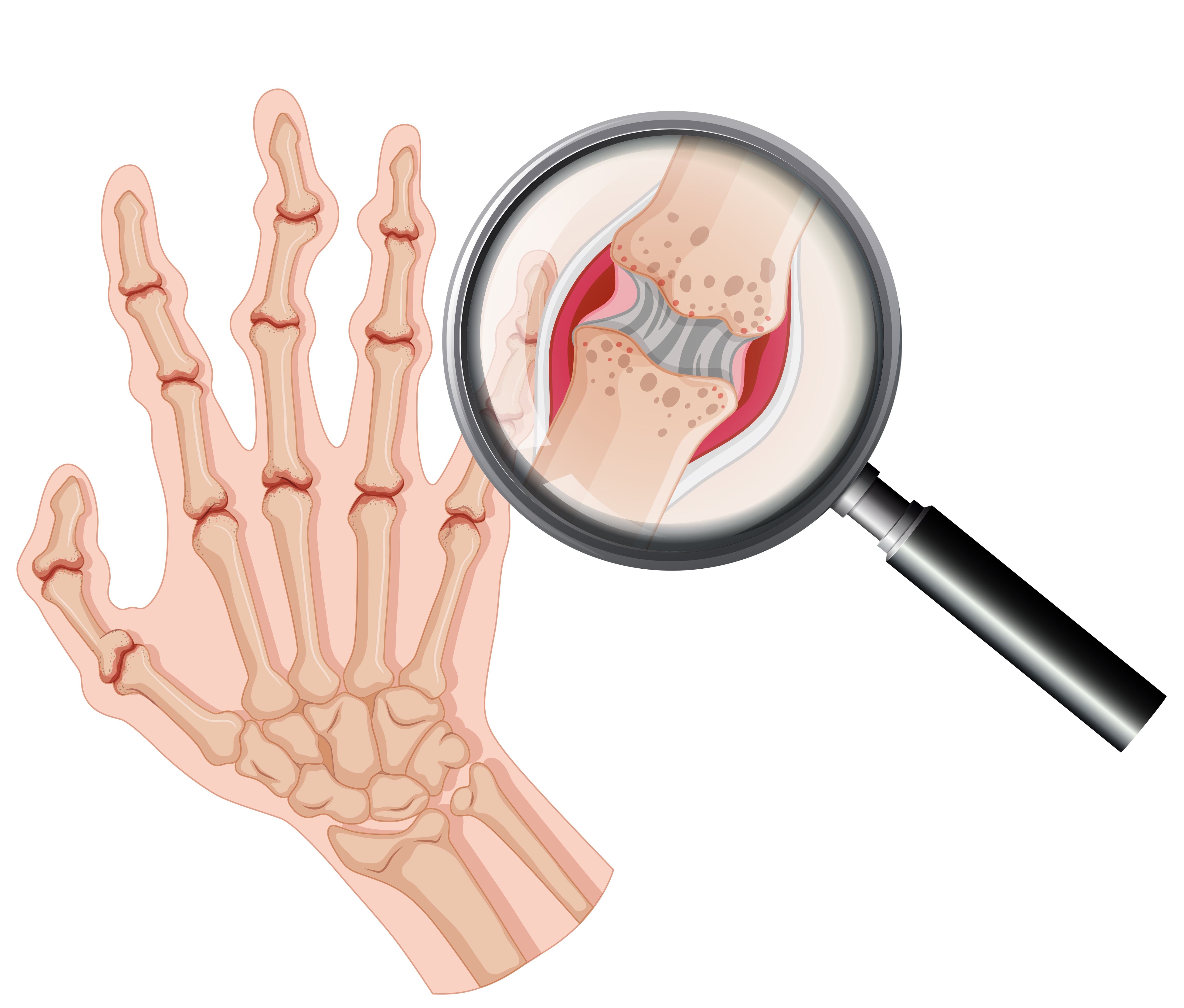 Rheumatoid Arthritis